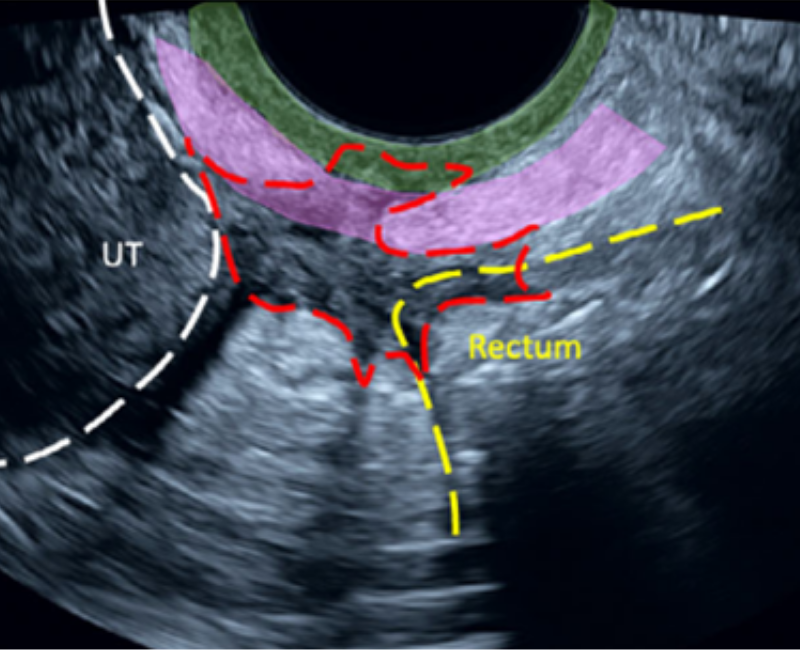 Are sonographers the future ‘gold standard’ in the diagnosis of endometriosis?